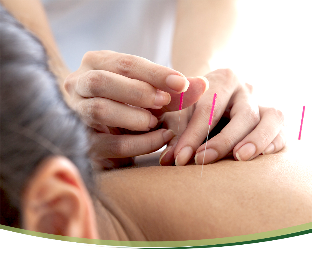 Akupunktur